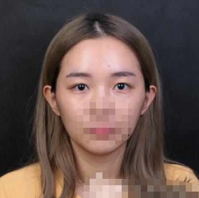 李登進(jìn)雙眼皮怎么樣