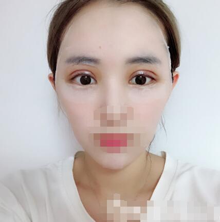 李登進(jìn)雙眼皮怎么樣