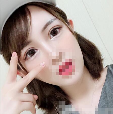 李登進(jìn)雙眼皮怎么樣