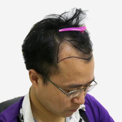 擺脫發(fā)型不好的日子，植發(fā)讓程序員小哥擺脫發(fā)型困擾！