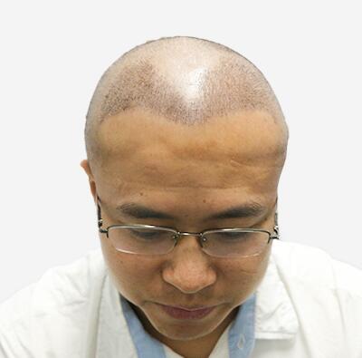 擺脫發(fā)型不好的日子，植發(fā)讓程序員小哥擺脫發(fā)型困擾！