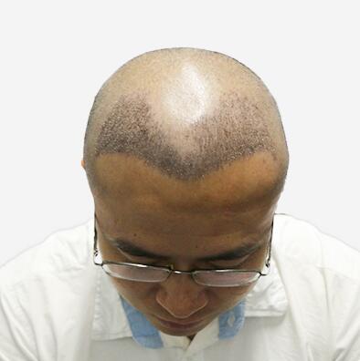 擺脫發(fā)型不好的日子，植發(fā)讓程序員小哥擺脫發(fā)型困擾！