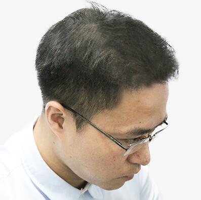 擺脫發(fā)型不好的日子，植發(fā)讓程序員小哥擺脫發(fā)型困擾！