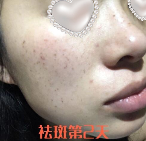 蚌埠祛斑體驗日記