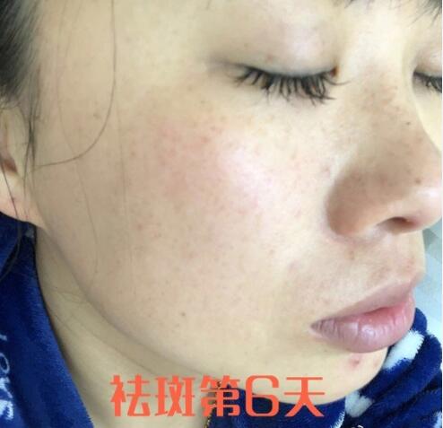 蚌埠祛斑體驗日記