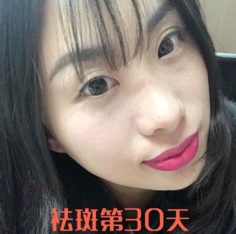 蚌埠祛斑激光術(shù)后果圖