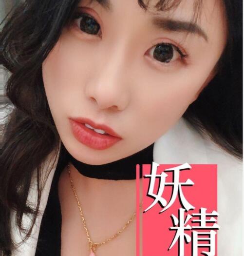 蚌埠祛斑激光術(shù)后果圖