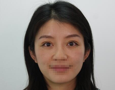 薛紅宇雙眼皮修復(fù)案例分享