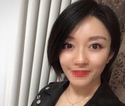 薛紅宇雙眼皮修復(fù)案例分享