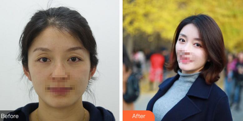 薛紅宇雙眼皮修復(fù)案例分享