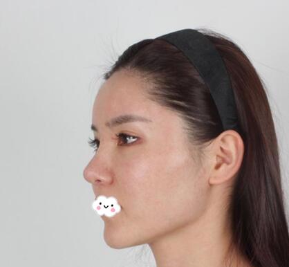 黃大勇改臉型案例分享