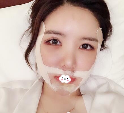 黃大勇改臉型案例分享