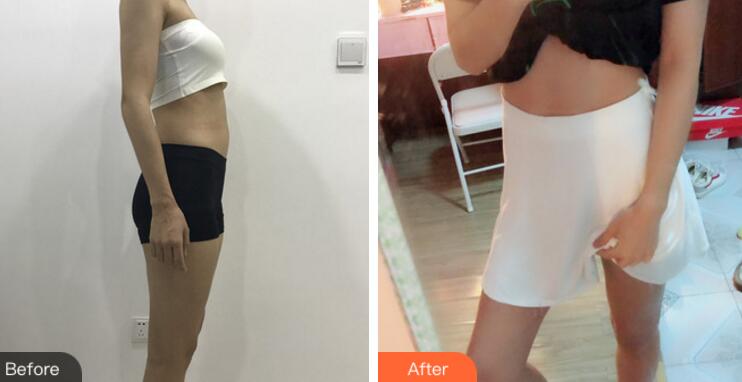 韓式共振吸脂減肥體驗(yàn)日記