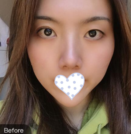 韓式三點(diǎn)定位雙眼皮手術(shù)日記