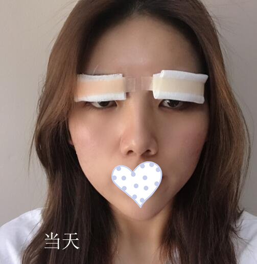 韓式三點(diǎn)定位雙眼皮手術(shù)日記