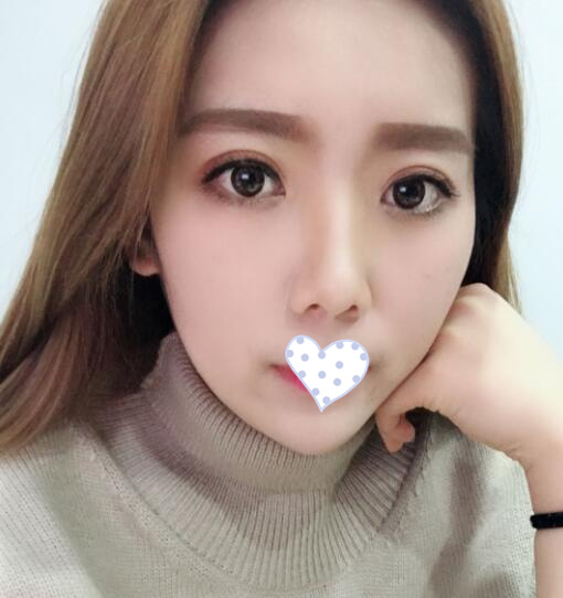 韓式三點(diǎn)定位雙眼皮果圖