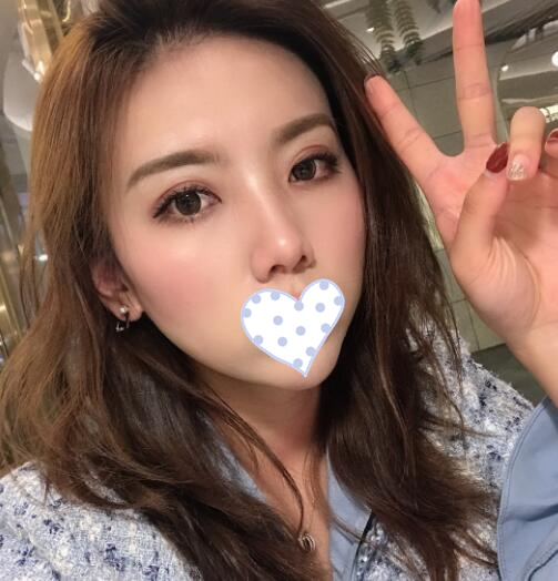 韓式三點(diǎn)定位雙眼皮果圖