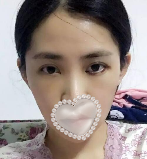 于海生醫(yī)生面部脂肪填充案例