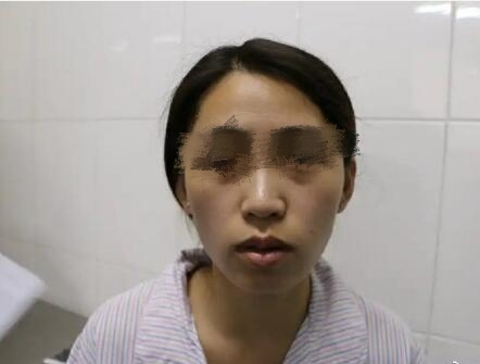 于海生醫(yī)生面部脂肪填充案例