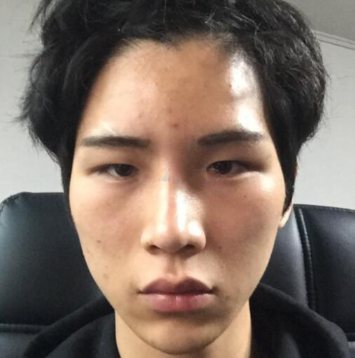 男生顴骨顴弓整形體驗(yàn)日記