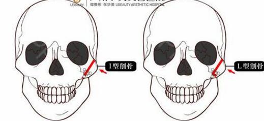 男生顴骨顴弓整形科普