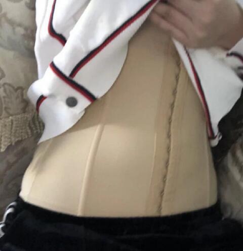 腰腹部吸脂減肥手術(shù)體驗日記