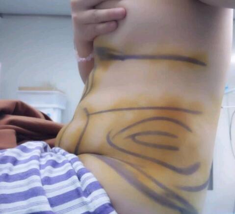 腰腹部吸脂減肥手術(shù)體驗日記