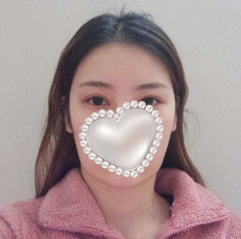 崔榮達做下頜角好嗎？案例分享