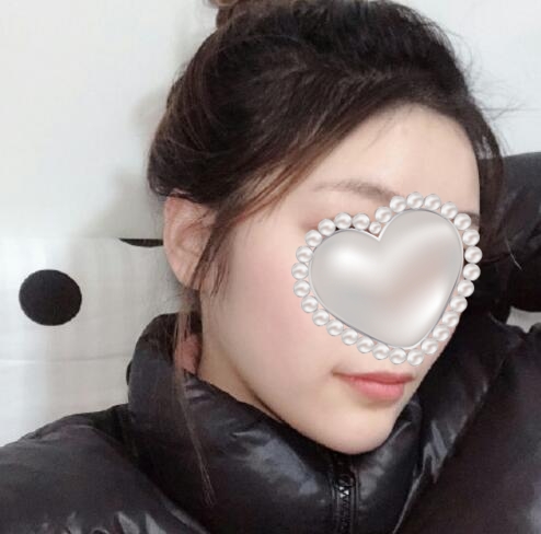 崔榮達做下頜角好嗎？案例分享