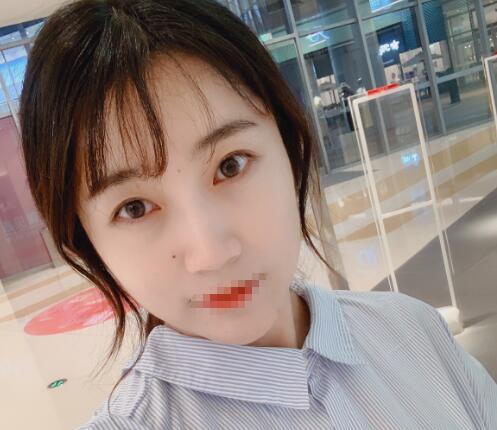 割雙眼皮前后對(duì)比圖分享