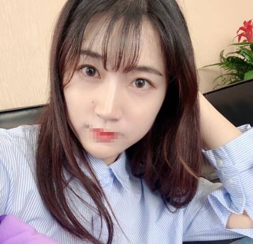 割雙眼皮前后對(duì)比圖分享