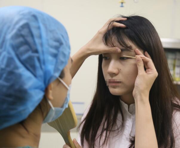 割雙眼皮手術(shù)經(jīng)過(guò)日記分享