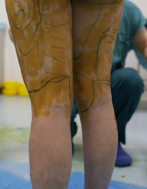 沒多少痛感瘦腿吸脂術(shù)體驗(yàn)過(guò)程