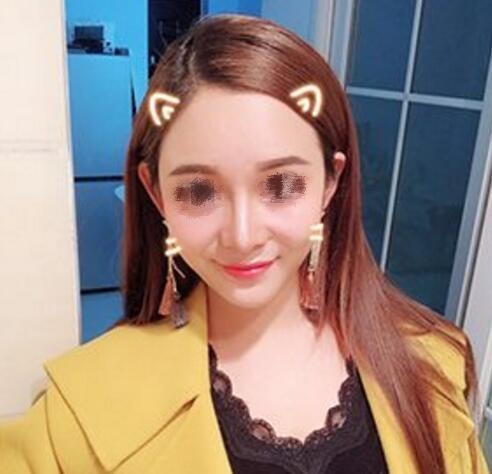 深圳四季醫(yī)療美容做鼻子案例分享