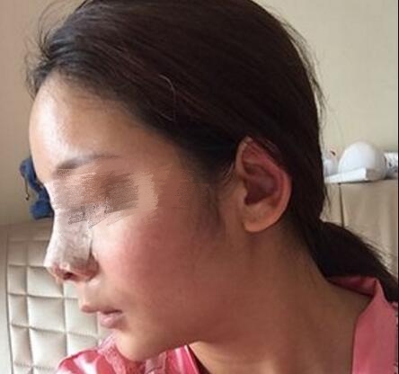 深圳四季醫(yī)療美容做鼻子案例分享