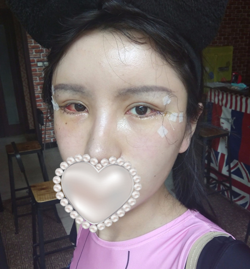 開(kāi)外眼角手術(shù)體驗(yàn)日記