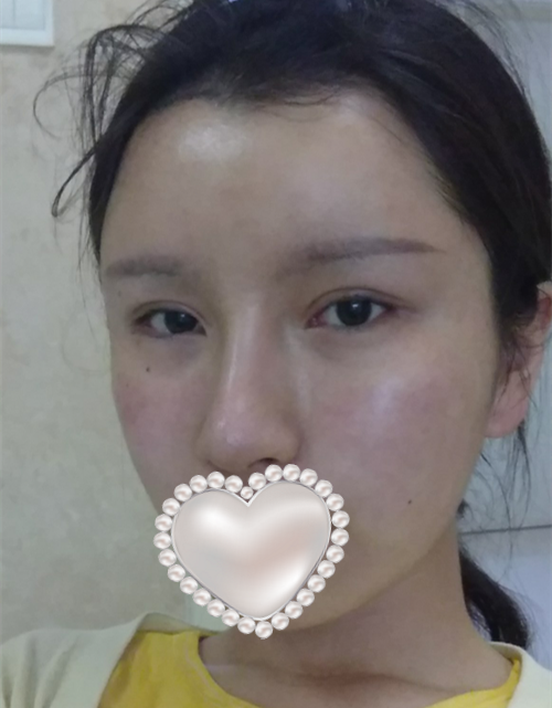 開(kāi)外眼角手術(shù)體驗(yàn)日記