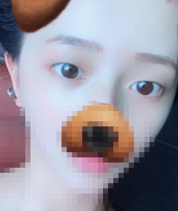 北京八大處趙延勇醫(yī)生做雙眼皮怎么樣？