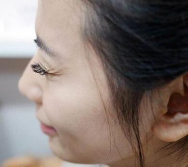 注射瘦臉祛除魚尾紋體驗日記