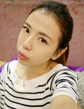 注射瘦臉祛除魚尾紋體驗日記