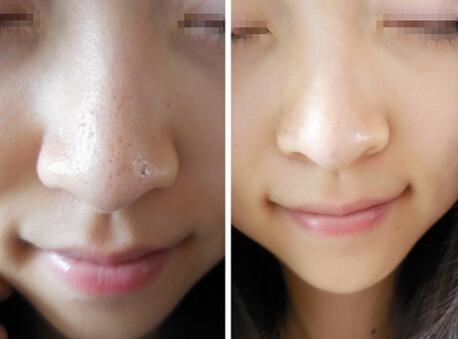 黑臉娃娃前后對(duì)比