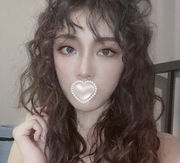 自體脂肪填充下眼瞼果圖