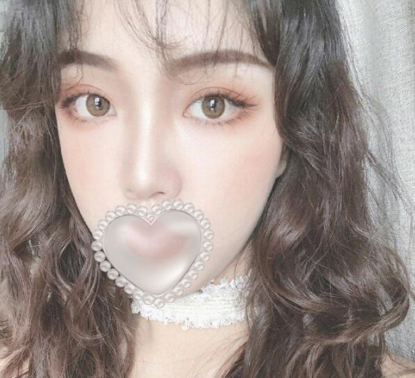 自體脂肪填充下眼瞼果圖