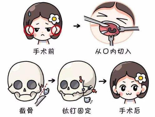 上海九院顴骨內(nèi)推手術(shù)科普
