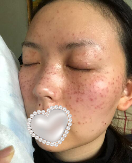 藍寶石激光祛斑體驗日記