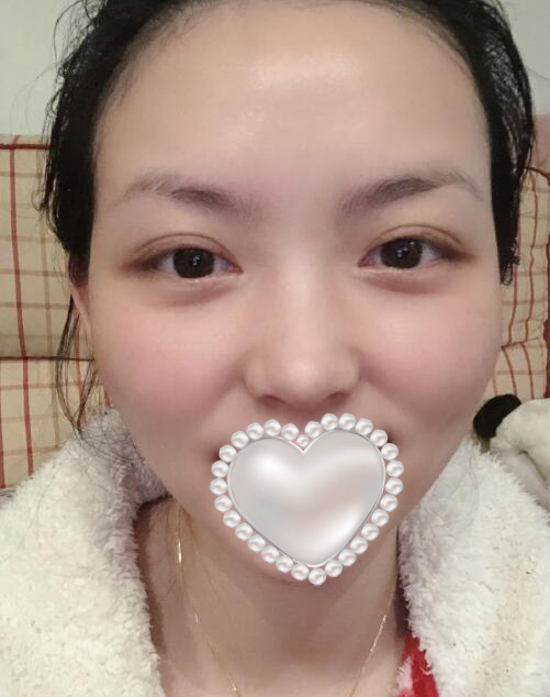 藍寶石激光祛斑果圖對比