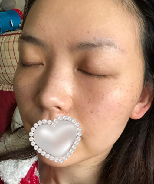 藍寶石激光祛斑果圖對比