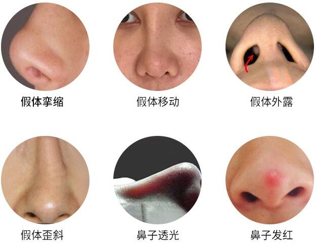 北京硅膠隆鼻的危害科普