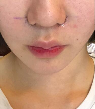 鼻頭鼻翼鼻尖整形過(guò)程日記分享