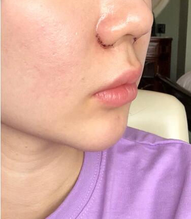 鼻頭鼻翼鼻尖整形過(guò)程日記分享